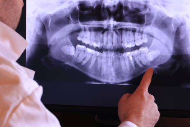 Best Emergency Dentist for Lost Fillings or Crowns in Paris, TX